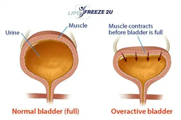 diagram of overactive bladder treatment Wrexham