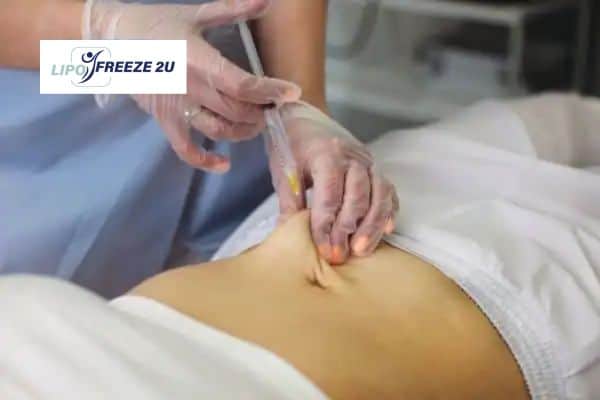 How Does Aqualyx Fat Dissolving Injection Work to Break Down Fat Wrexham?