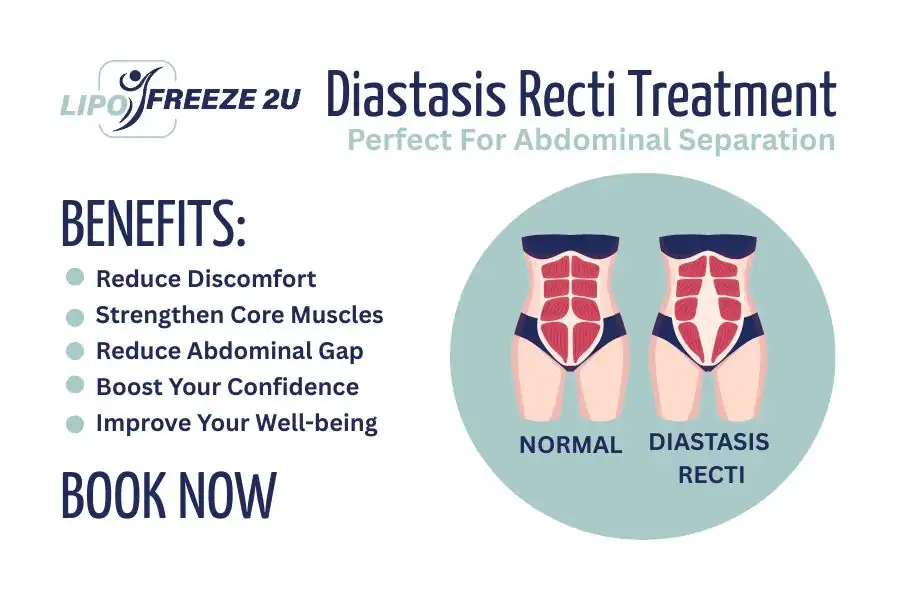 Benefits of body toning treatment Wrexham for Diastasis recti