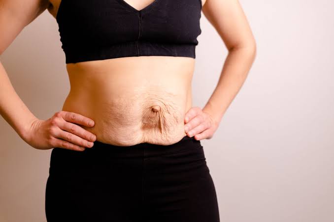 Is Surgery Really the Only Way to Repair Diastasis Recti Wrexham?