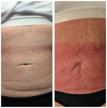 How Does RF Microneedling Improve Crepey, Thin and Uneven Skin Texture Wrexham?