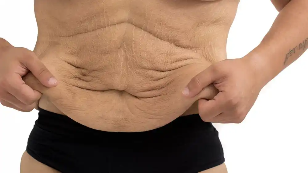 RF Microneedling for Loose Skin: How Can It Help Tighten and Reshape the Skin Wrexham?